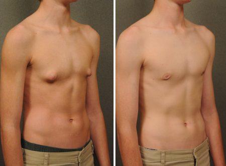 How can i get rid of puffy nipples?