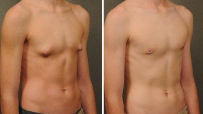 How can I get rid of puffy nipples?