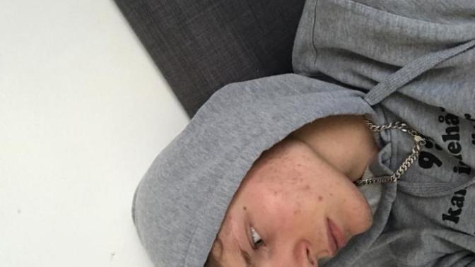 Does acne make a guy less attractive?