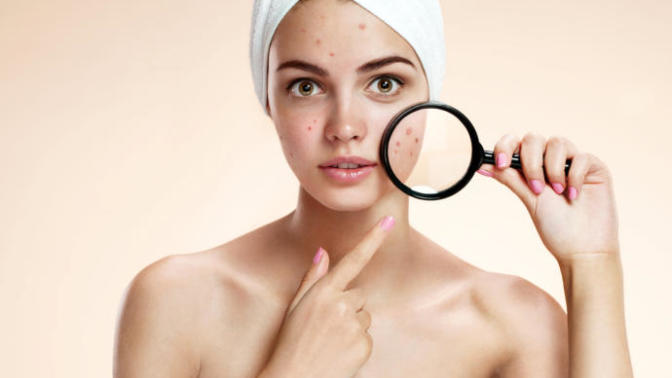 Acne tips/hacks or things that could help me? :)?