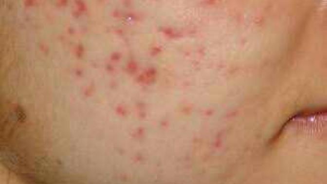 Get rid of Acne scars?
