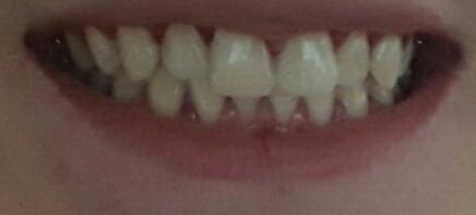 Do i have bad teeth?