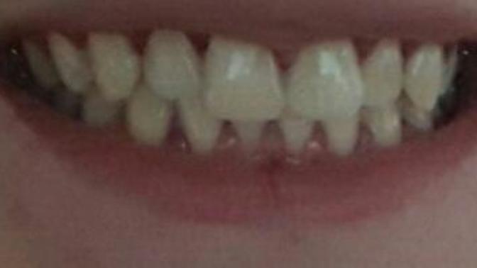Do I have bad teeth?