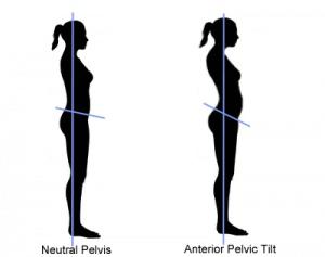 How can I get rid of anterior pelvic tilt (ATP)?