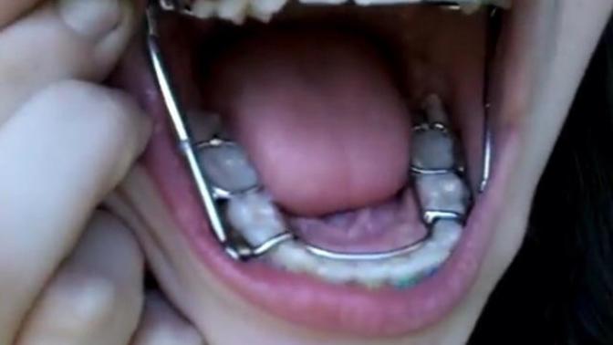 I went to have my braces adjusted and my ortho put this thing on. Anyone else have this?
