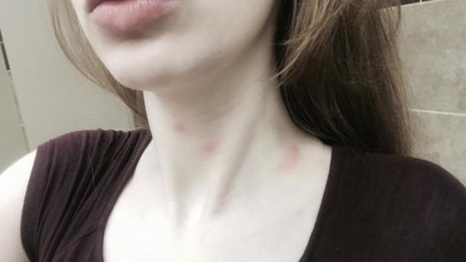 Do these big bites look like hickies?