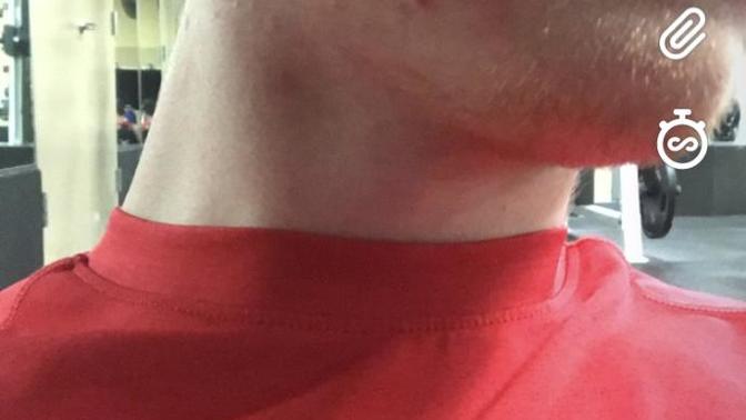 Is my acne bad? Is it why I am having trouble getting girls I find attractive?