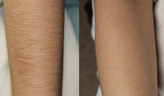 Hair on girls arms?