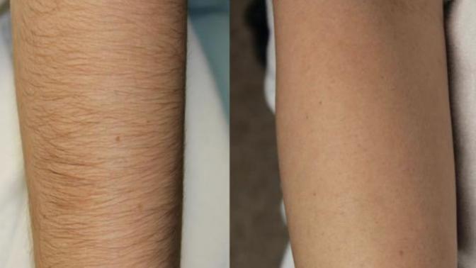 Hair on girls arms?