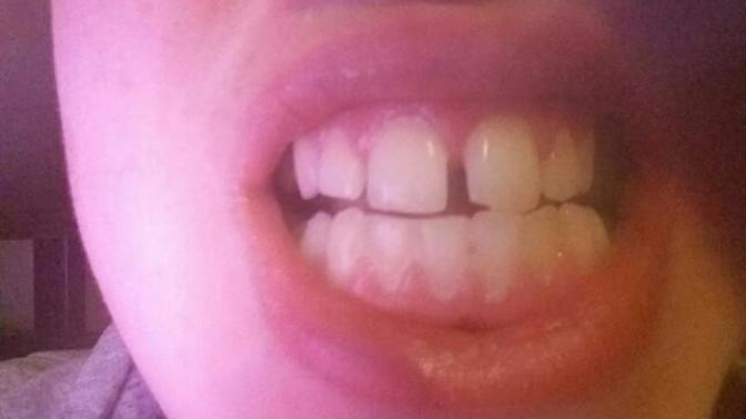 On a scale of 1-10 how bad are my teeth in terms of straightness?