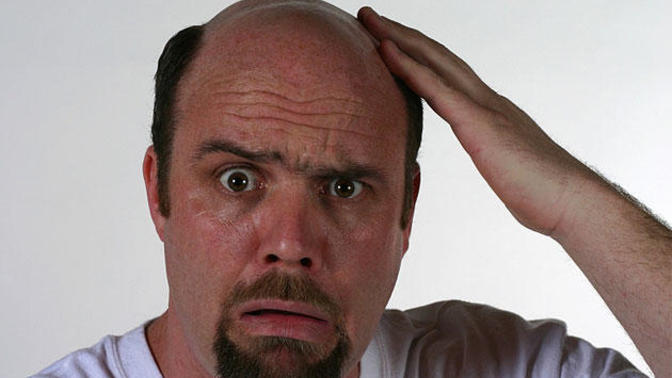 Bald/balding guys, how were you able to come to terms with the unfortunate truth that you were losing your hair?