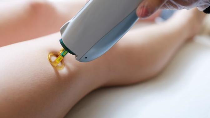 Is laser hair removal safe?