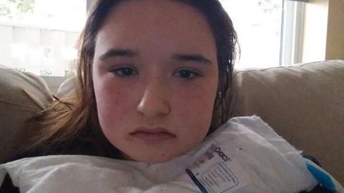 Reducing swelling after wisdom teeth removal and double frenectomy?