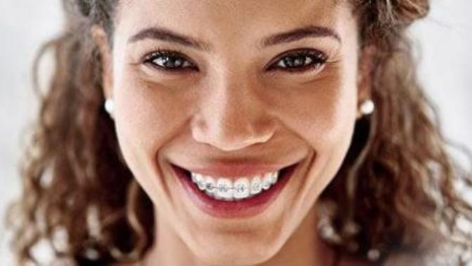 Guys, what do you think of braces?
