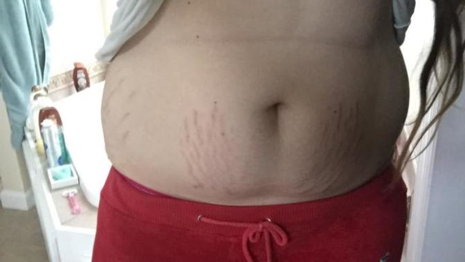 Do you think I should wear a low or high waisted bikini? I have bad stretch marks and a muffin top? Going to Disney?