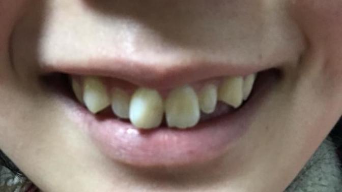 I want to ask guys from the US, would you date a Japanese girl with crooked teeth?