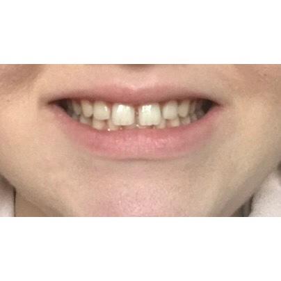 Should I get braces?
