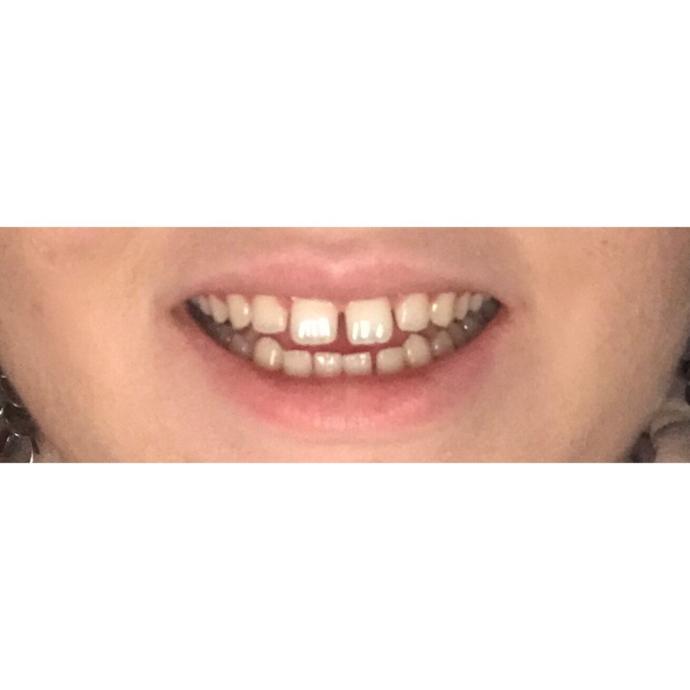 Should I get braces?