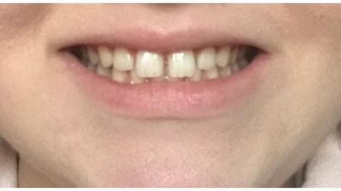 Should I get braces?