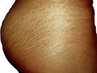 Does stretch marks bother you?