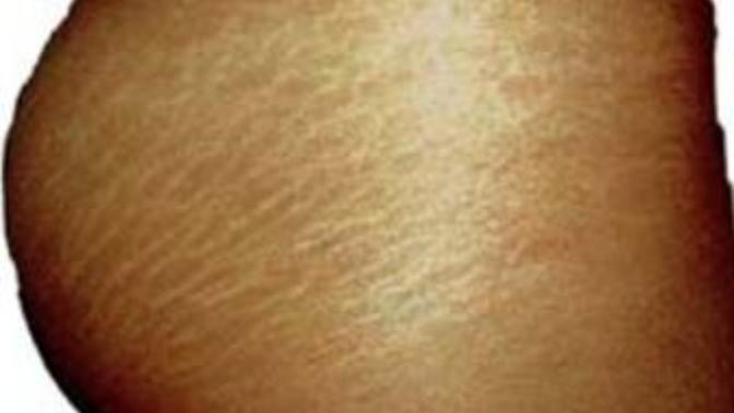Do stretch marks bother you?