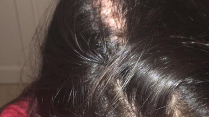I have trichotillomania, and it’s getting very bad?