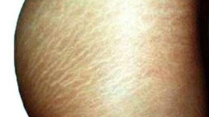 Stretch marks? What do you think?