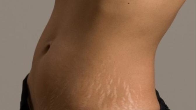 Stretch marks.. what do you think?