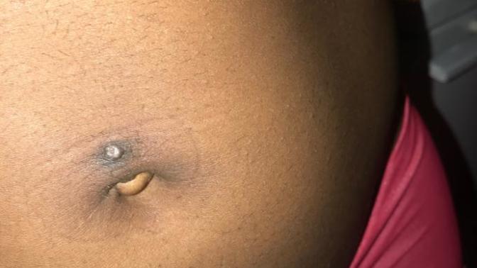 I took my belly piercing out and this is what it looks like. what should I do & what happened?