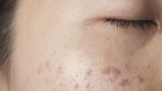 Acne scars... Help?
