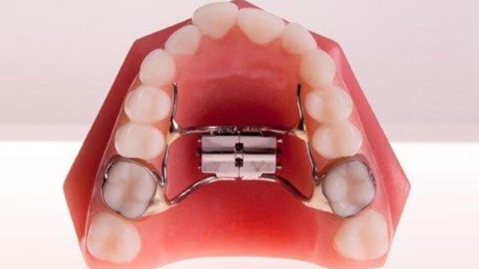 Would it be fine if I made YouTube videos with a palatal expander in my mouth?