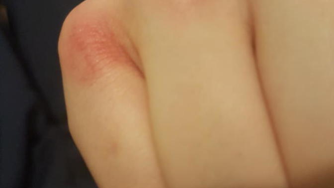 My finger is twitching after boxing and there's a red patch on my knuckle?