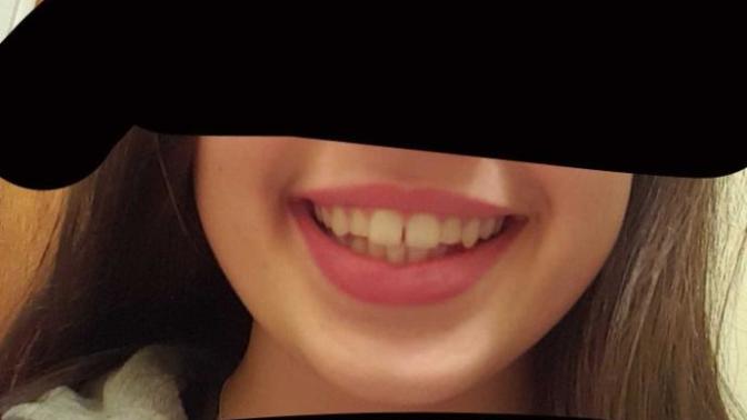Is it fine that I have a gap between my teeth?