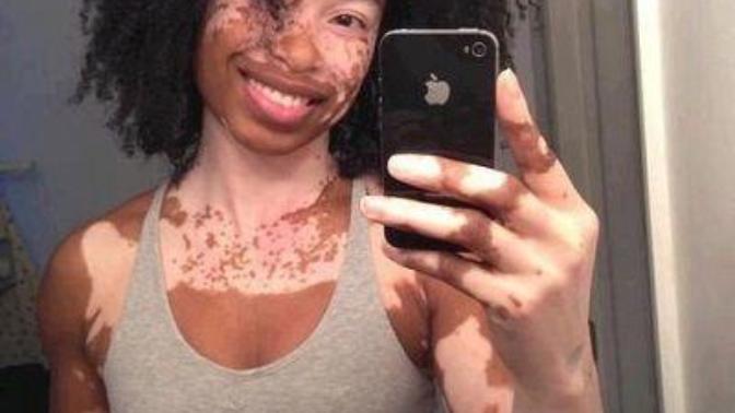 Would you be willing to date or marry someone with Vitiligo?
