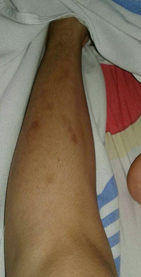 What do you think of these dark spots on my leg??