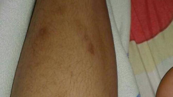 What do you think of these dark spots on my leg?