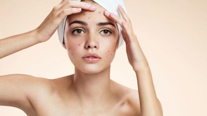 How do you deal with having acne/bad skin?