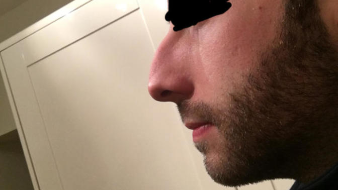 Should I get a nose job?