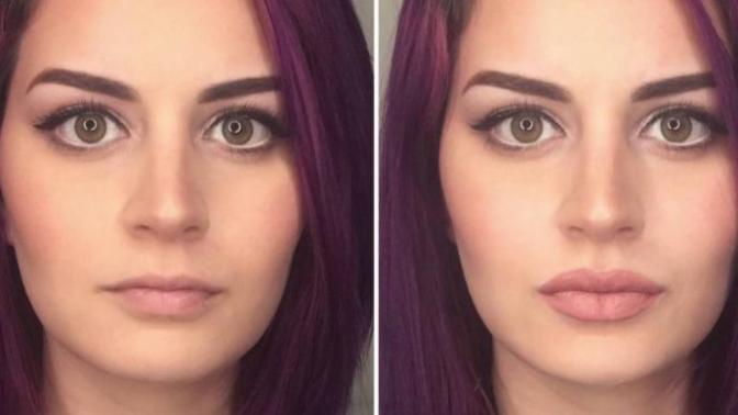 Guys, what is your opinion on women getting lip fillers?