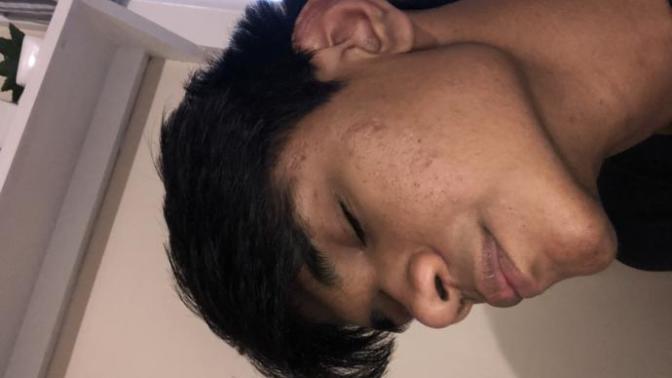Will these small scars go away eventually?