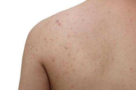 Guys, do you mind back acne??