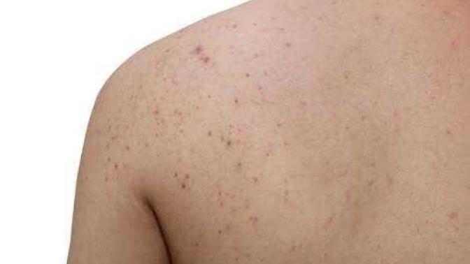 Guys, do you mind back acne?
