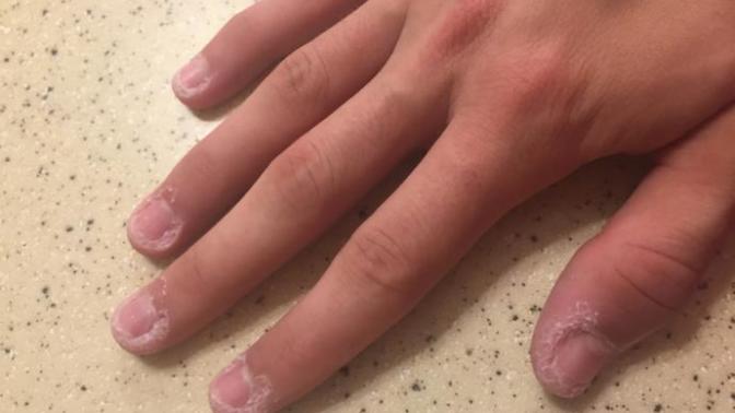 Is it weird to bite the skin around your fingernails?