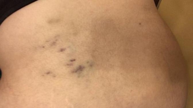 Mysterious bruising?