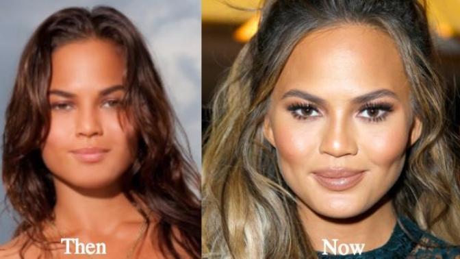 Cheek fillers/implants?