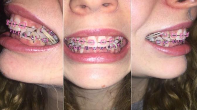 Do you think people don't want to kiss me because of my braces?