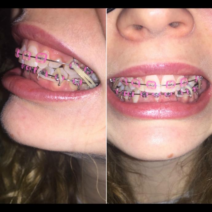Girls, Is my smile off putting because of my braces?