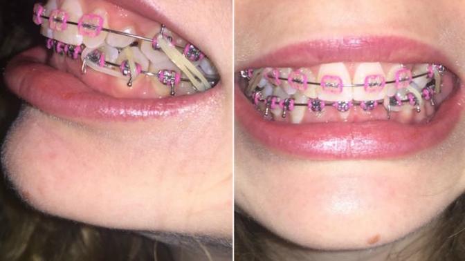 Girls, Is my smile off putting because of my braces?