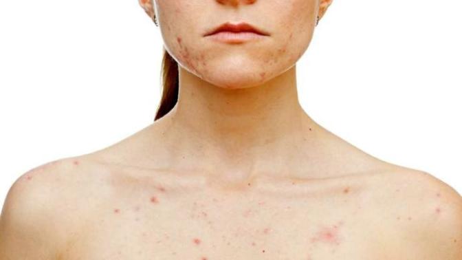 Thoughts/opinion on girls with body/chest acne?