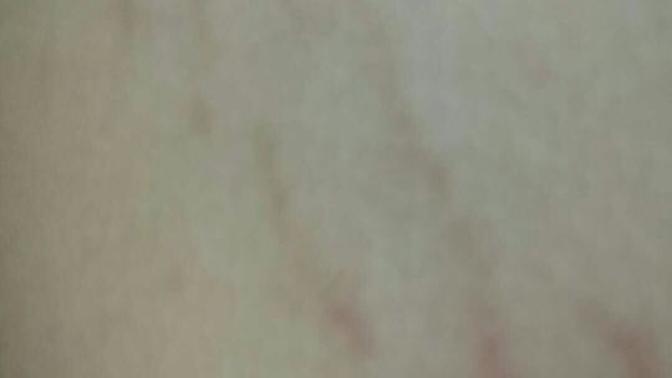 Are these stretch marks?